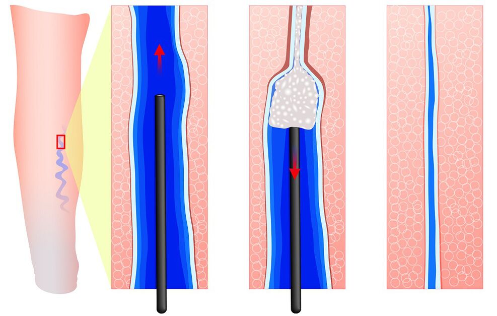 Mechanizmus skleroterapie